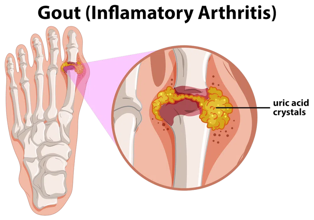 Schematische Darstellung von Gicht (Entzündliche Arthritis) im Fuß