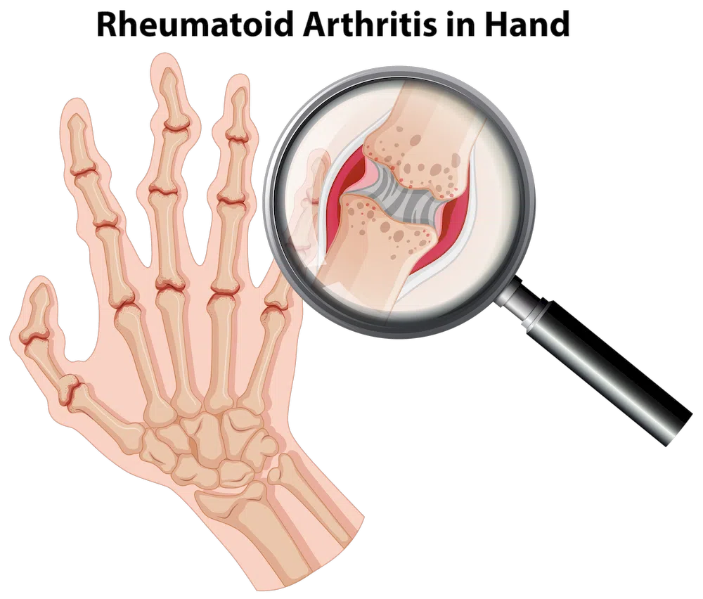 Schematische Darstellung von Rheumatischer Arthritis in den Fingern