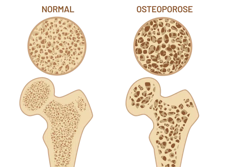 Osteoporose Knochendichte Vergleich