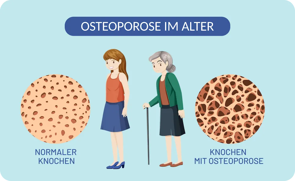 Osteoporose im Alter