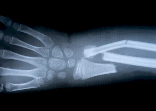 Röntgen Bruch Unterarm - Osteoporose
