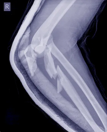 Röntgen Bruch Unterschenkel - Osteoporose