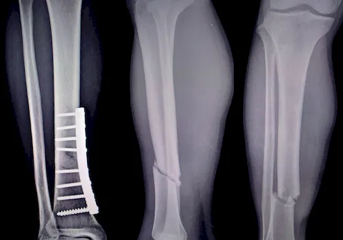 Röntgen Bruch Unterschenkel mit Spondylodese - Osteoporose