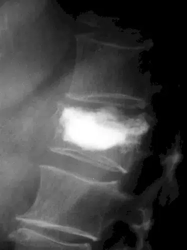 Röntgen - Wirbel mit Knochenzement