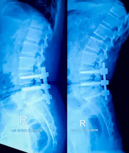 Röntgen Wirbel mit Schrauben