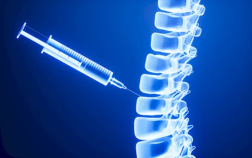 Spritze in Wirbelkörper