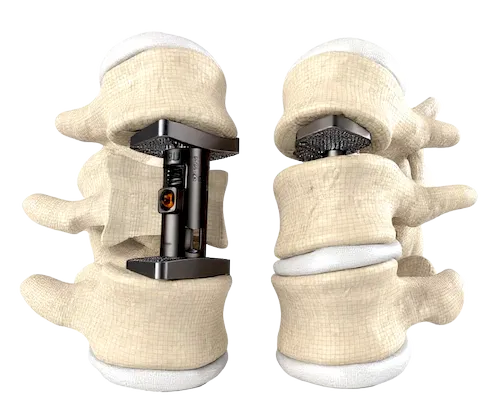 Wirbelkörperersatz Osteoporose